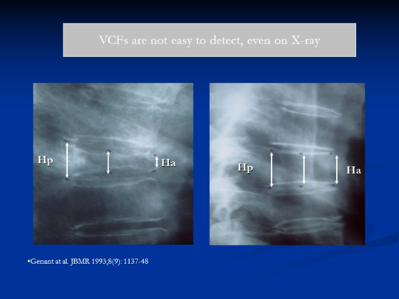 VCFs are not easy to detect, even on X-ray Genant at al. JBMR 1993;8(9):